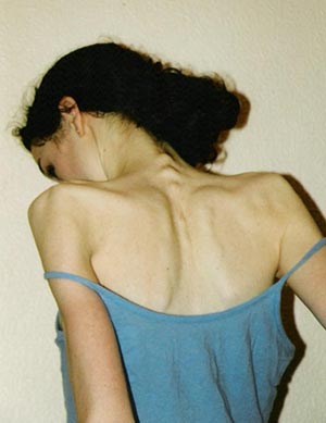 anorexia1.jpg